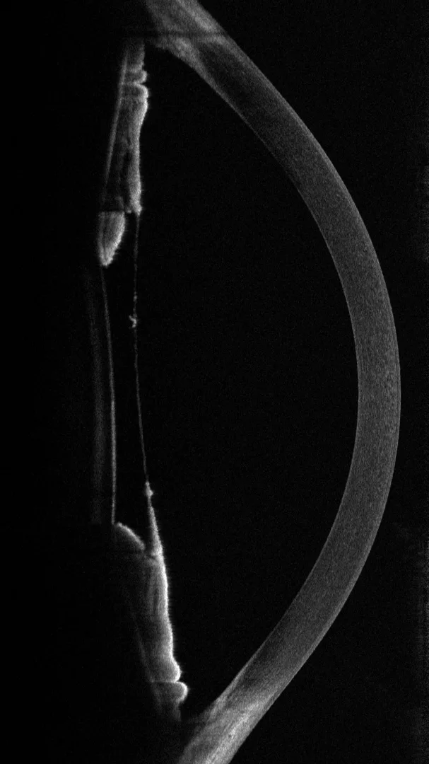 Membrana pupillare persistente: un ponte attraverso la pupilla