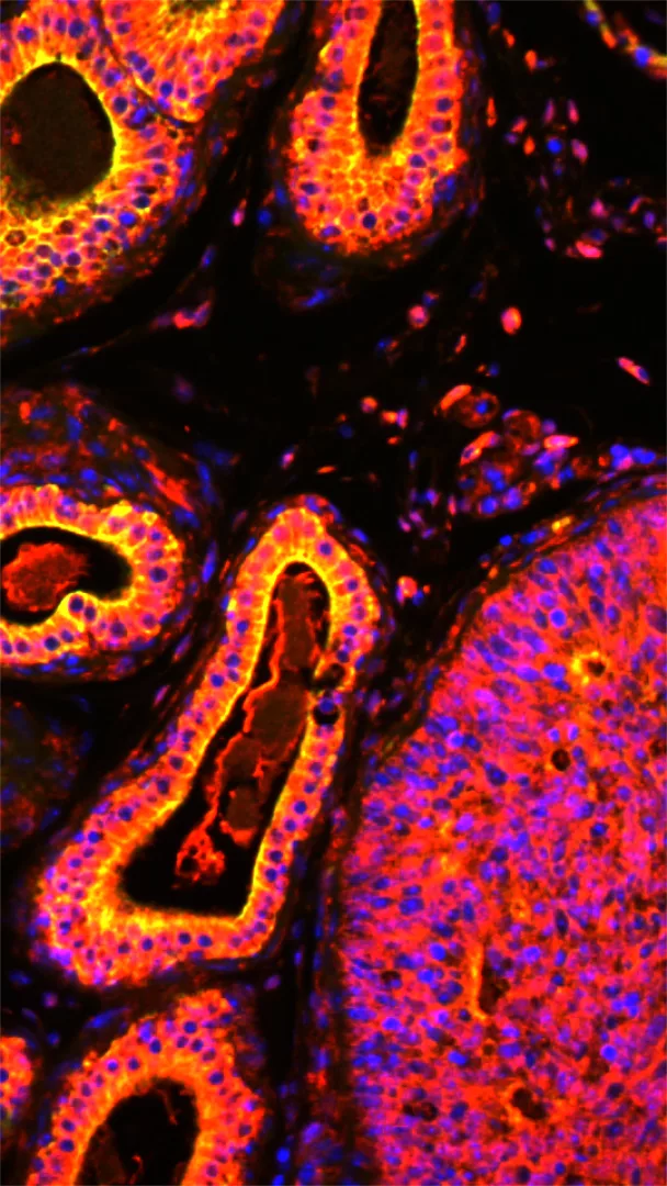 La metamorfosi del tumore: viaggio attraverso il microscopio a fluorescenza