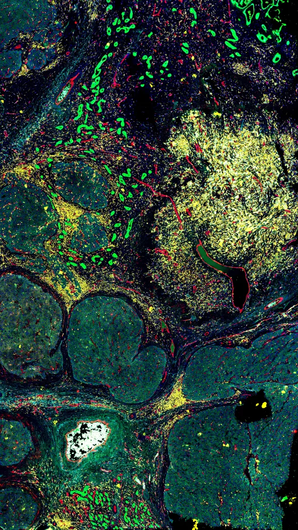 Cartografia di un carcinoma epatico